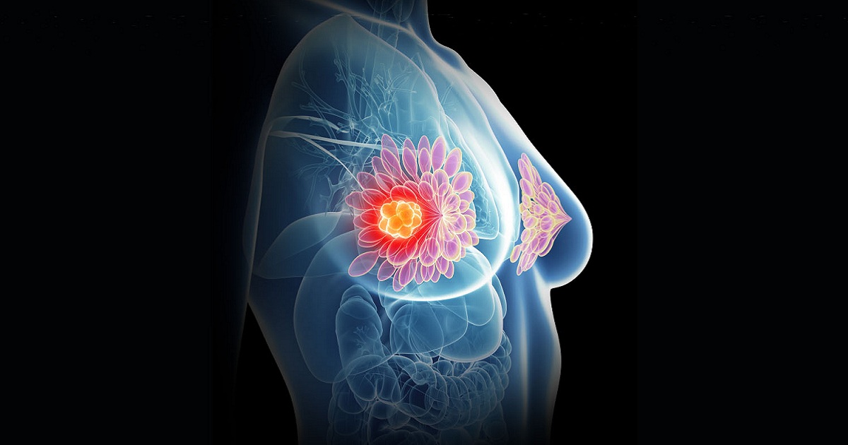Рак молочной железы: важность ранней диагностики и новые методы лечения